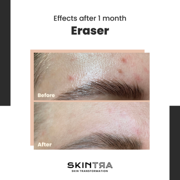 SkinTra Eraser Serum for Hyperpigmentation with Vitamin C 10% 30ml - Image 2