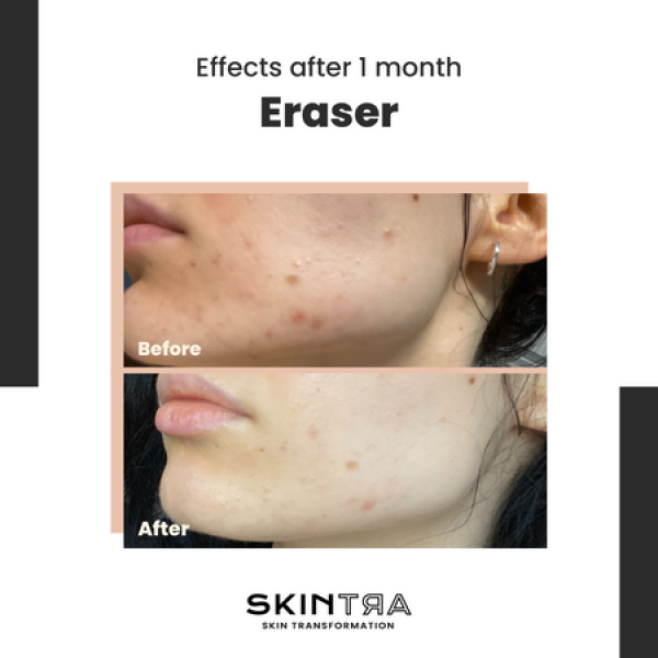 SkinTra Eraser Serum for Hyperpigmentation with Vitamin C 10% 30ml - Image 3